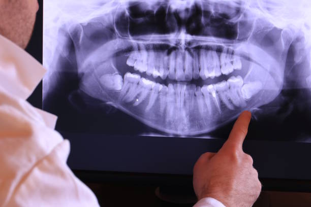 Best Emergency Dental Extractions in Lone Star, TX